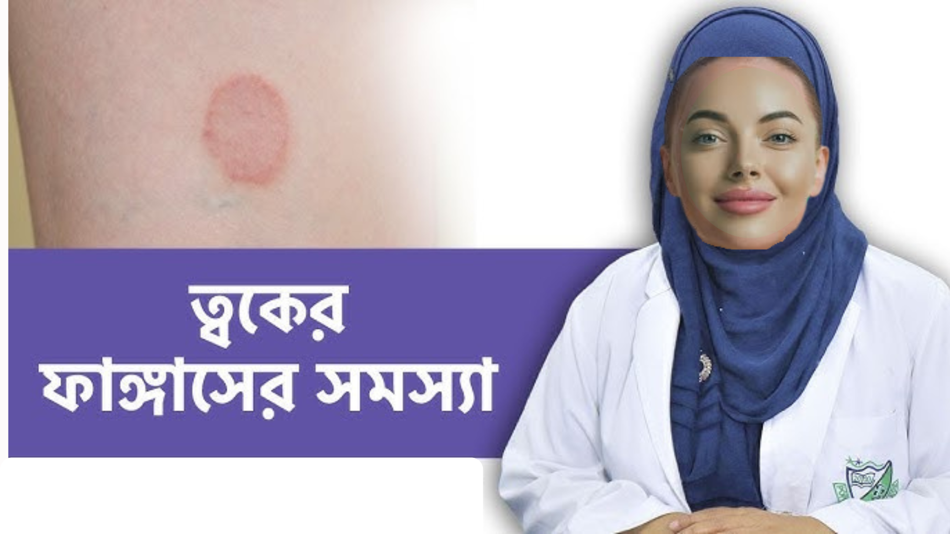 নারীদের গোপনাঙ্গে ফাঙ্গাল সংক্রমণ কেন হয়: কারণ, লক্ষণ, চিকিৎসা ও প্রতিরোধ