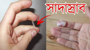 গোপনাঙ্গে অতিরিক্ত স্রাব (Vaginal Discharge) কেন হয়: কারণ, লক্ষণ, প্রতিরোধ ও সমাধান